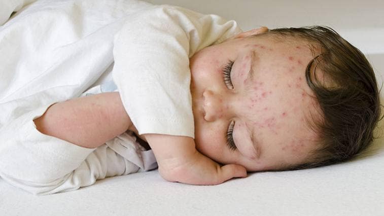 A kiütések a betegség jelei: Ismerje fel időben a tüneteket!