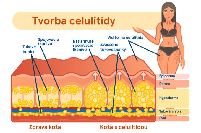 Celulitídu vymasírujte, vypoťte a vyplavte 