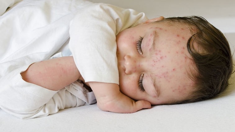 Pozor na febrilné kŕče! Má dieťa horúčku alebo zvýšenú teplotu?