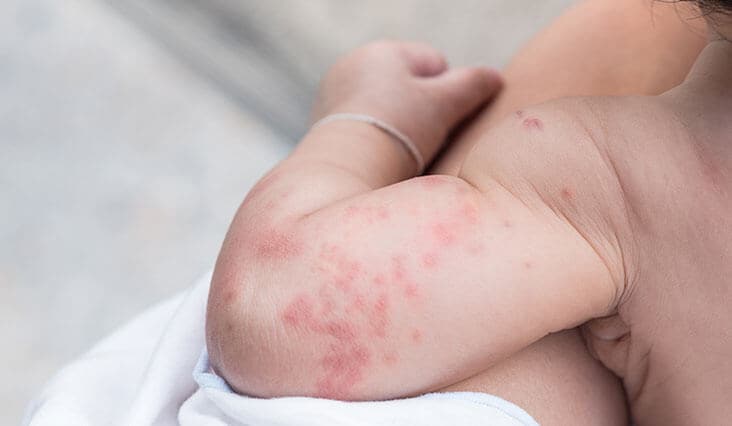 Így óvhatja kisbabája bőrét