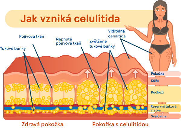 Celulitidu rozmasírujte, vypoťte a vyplavte