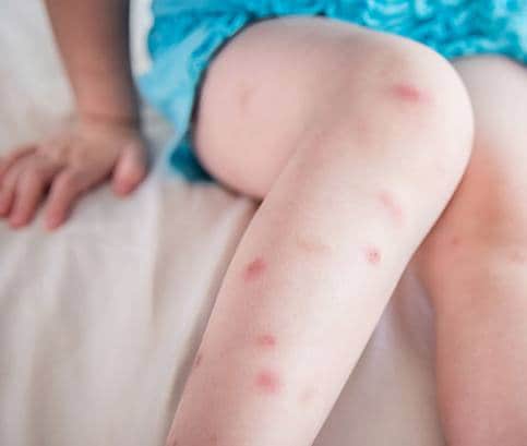 Čo uštiplo vaše dieťa? Odhaľte vinníka podľa bodnutia 