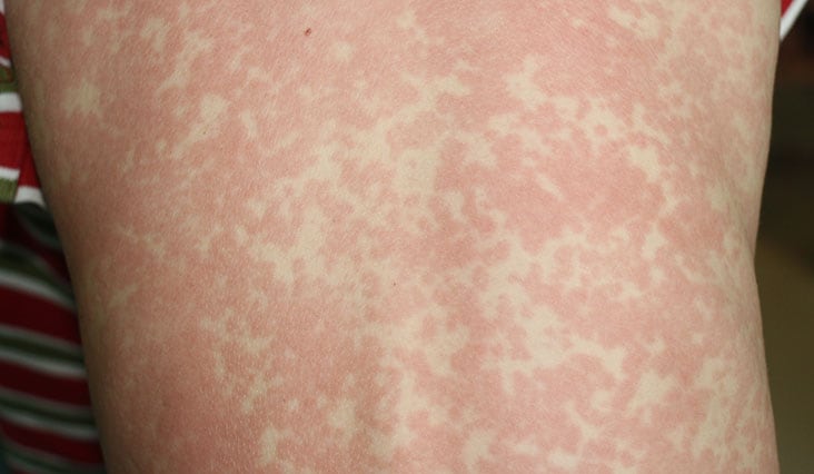 A kiütések a betegség jelei: Ismerje fel időben a tüneteket!