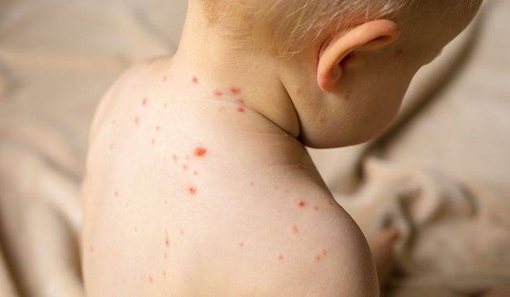 A kiütések a betegség jelei: Ismerje fel időben a tüneteket!