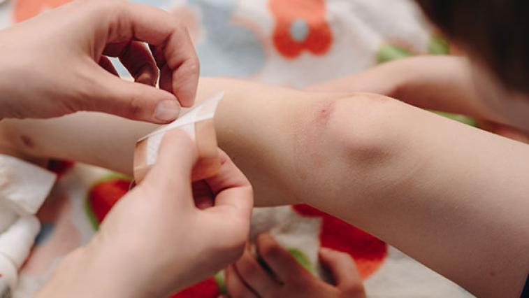 Modřiny: Jak se jich zbavíte co nejrychleji?