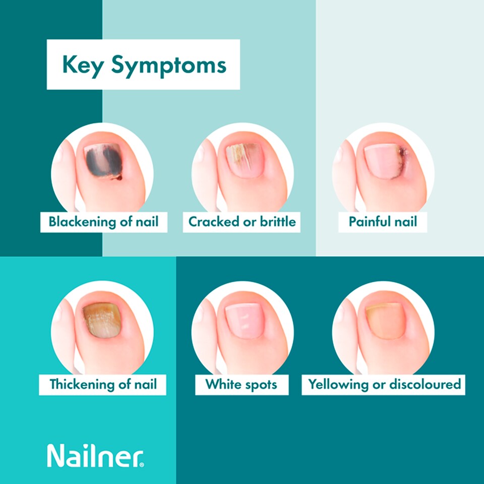 image 1 of Nailner Treat & Colour Nail Treatment for Fungal Infection 10Ml