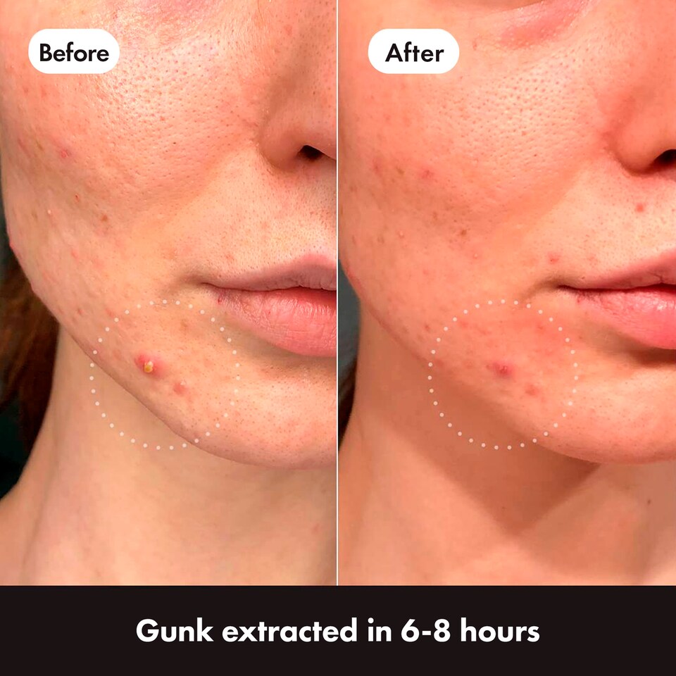 image 1 of Hero Mighty Patch Duo 12 Pack