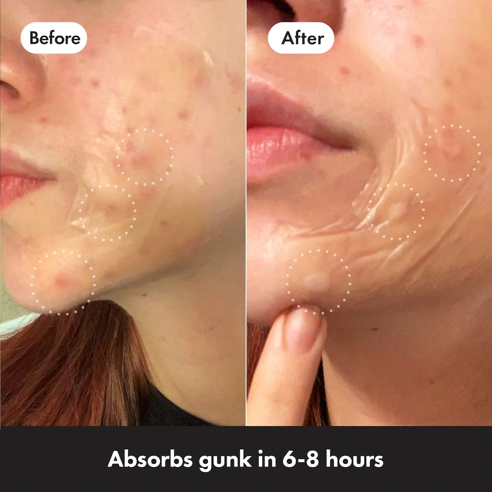 image 1 of Hero Mighty Patch Surface 10 pack