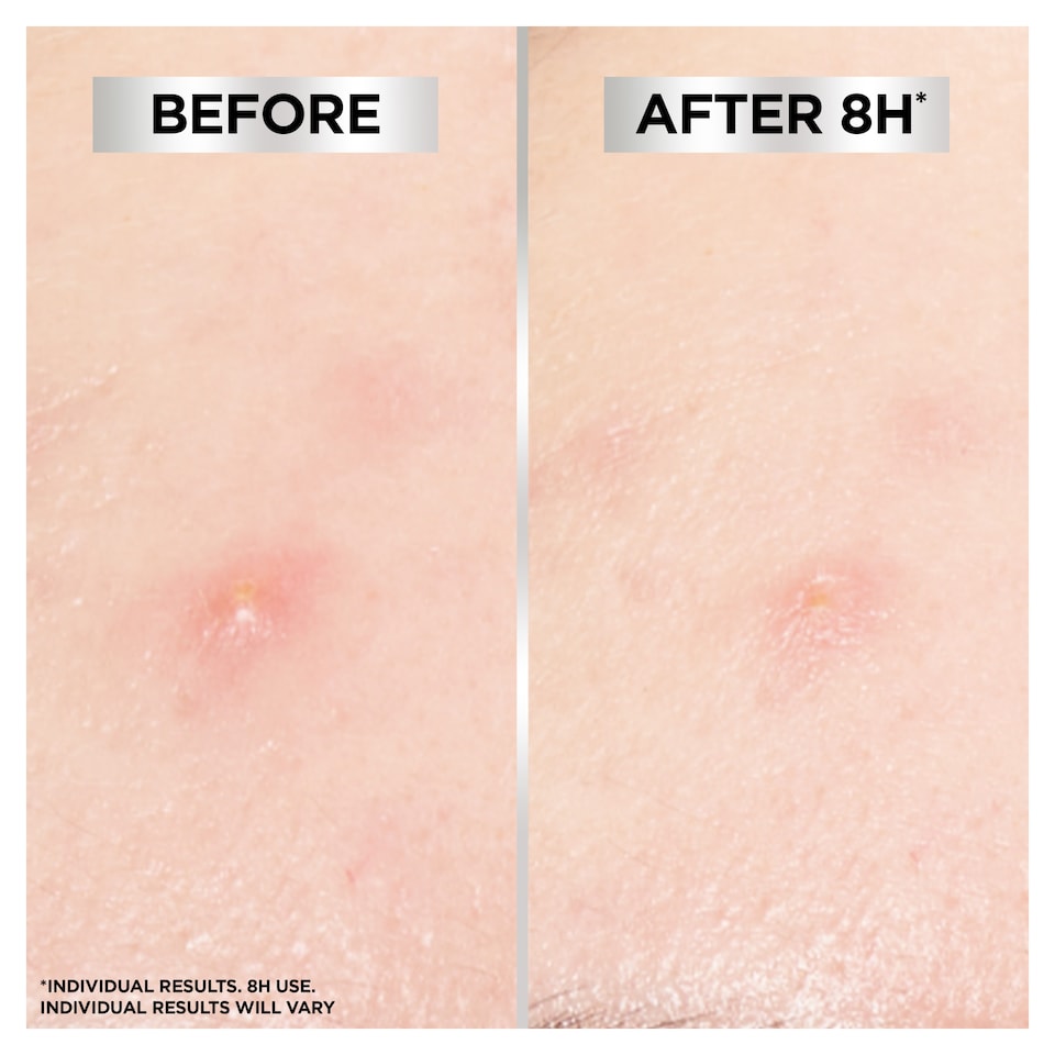 image 1 of Garnier Pure Active Invisible Blemish Patches 44 Pack