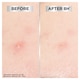 image 3 of Garnier Pure Active Blemish Patch 22 Pack