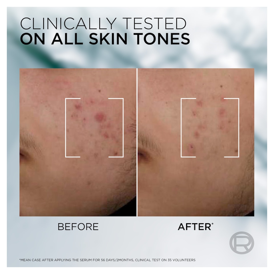 image 1 of L'Oreal Men Expert Derma Control Niacinamide Anti-Blemish Serum 30ml