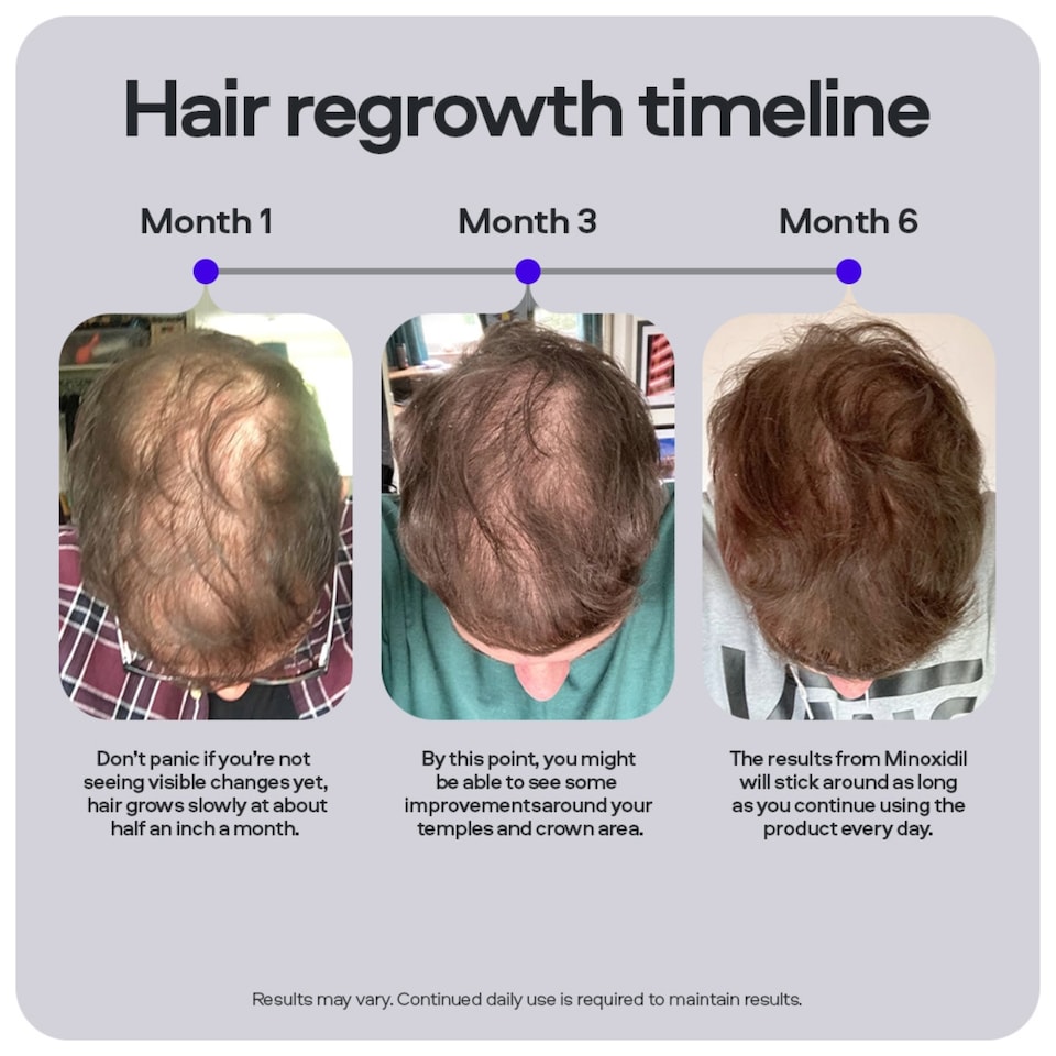 image 1 of Sons Minoxidil 5% Spray (1x60ml), Hair Growth Shampoo (1x200ml) & 0.25mm Dermaroller for Men