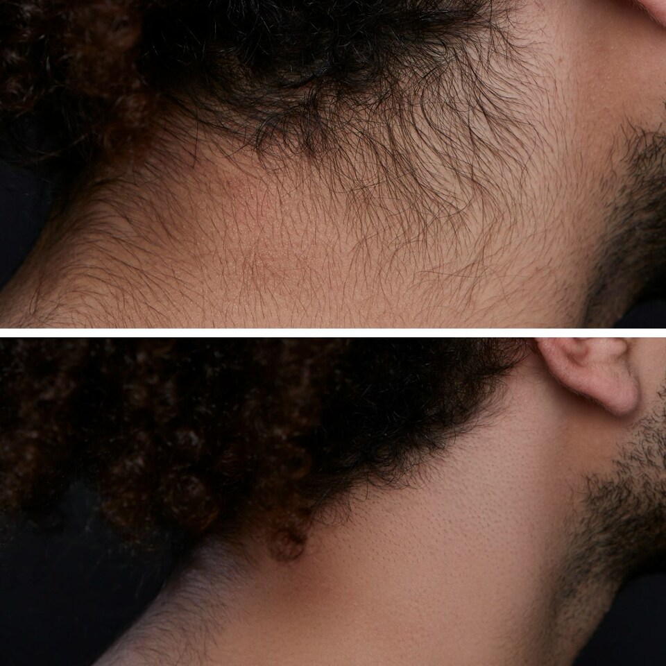 image 1 of Men's Touch Up Razor - Hair Removal & Dermaplaning Tool