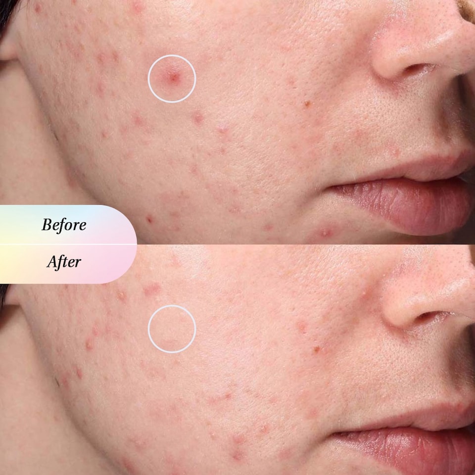 image 1 of Invisapatch™ Repair Barrier Hydrocolloid Spot Patch