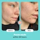 image 3 of Skin Choice Breakout Patch Classic, Hydrocolloid Spot Acne Pimple Patches - 75pk