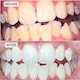 image 4 of Smile Science Harley Street Teeth Whitening Treatment Kit