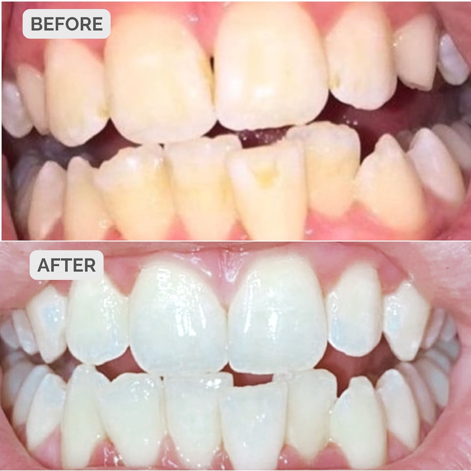 image 1 of Smile Science Harley Street Teeth Whitening Treatment Kit
