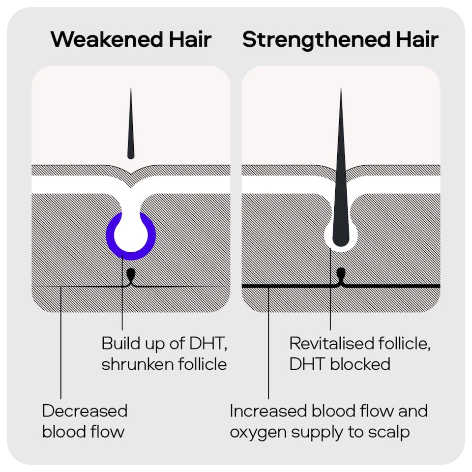 image 1 of Sons Minoxidil 5% Spray & 0.25mm Dermaroller for Hair Loss, 3 Month Supply