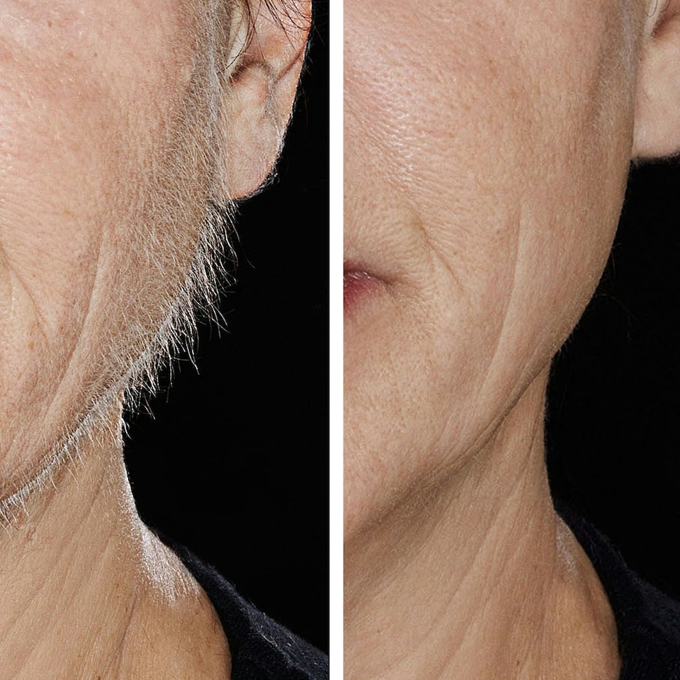 image 1 of Dermaplaner Single
