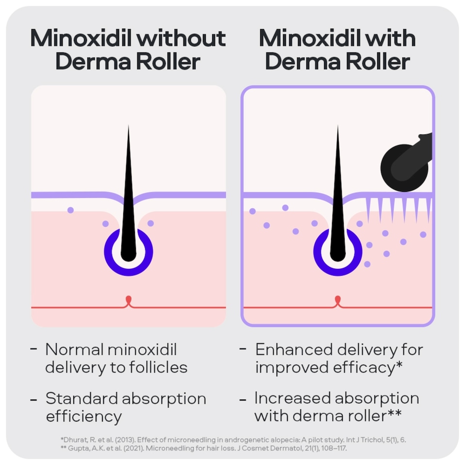 image 1 of Sons Minoxidil 5% Spray (3x60ml), Hair Growth Shampoo (3x200ml) & 0.25mm Dermaroller for Men