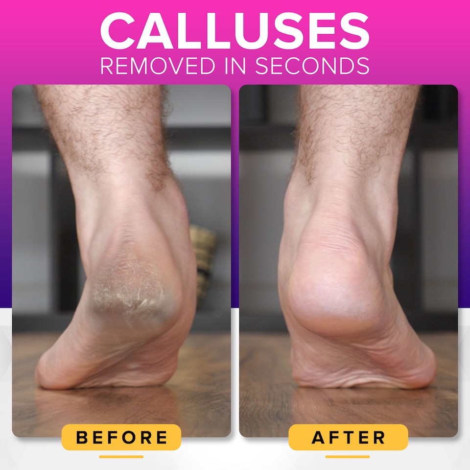 image 1 of NYK1 MegaFile Callus Remover for Feet with Catcher (XL Size) Rustproof Foot File for Wet & Dry Use